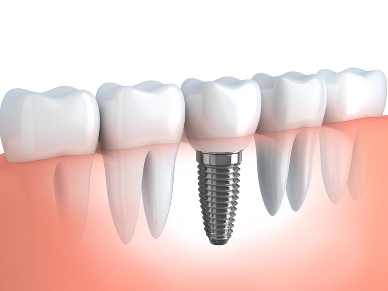 Dental Implants Burlington, MA