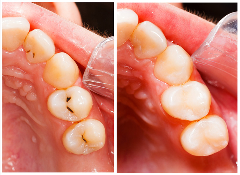 Fillings Burlington, MA