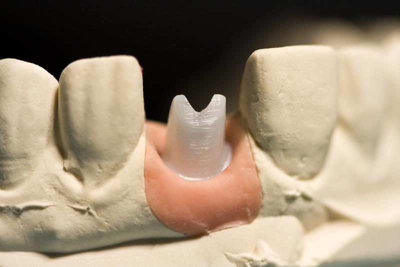 Implant Restoration Burlington, MA