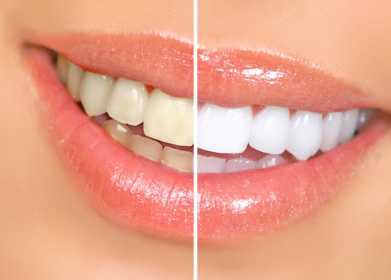 Teeth Whitening Burlington, MA