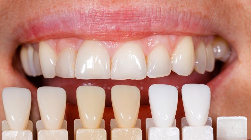 Veneers Burlington, MA